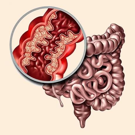 Restoring Gut Balance, the Ayurvedic Way